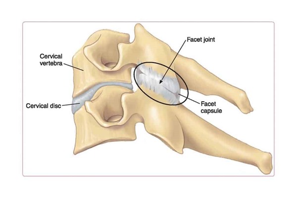 12 Treatments to Help Deal with Facet Joint Syndrome Pain